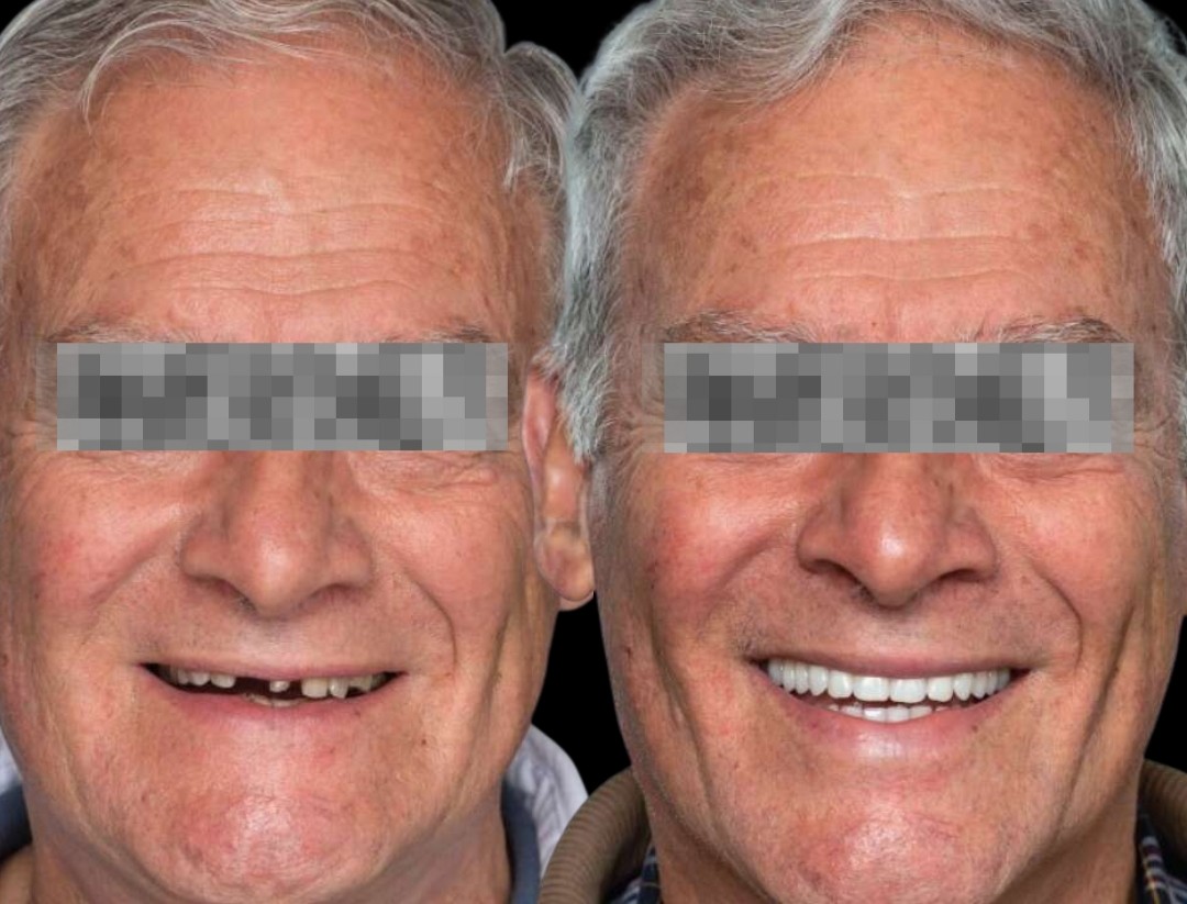 Caso 6 — prima e dopo